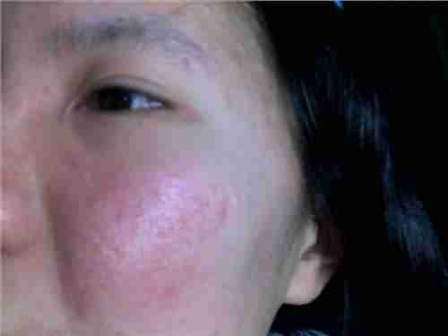 Ƥ�������ĳ���Σ��-lni