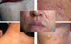 毛囊炎危害大,损形象伤自尊-lni