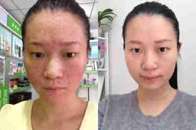 毛囊炎危害大,损形象伤自尊-lni