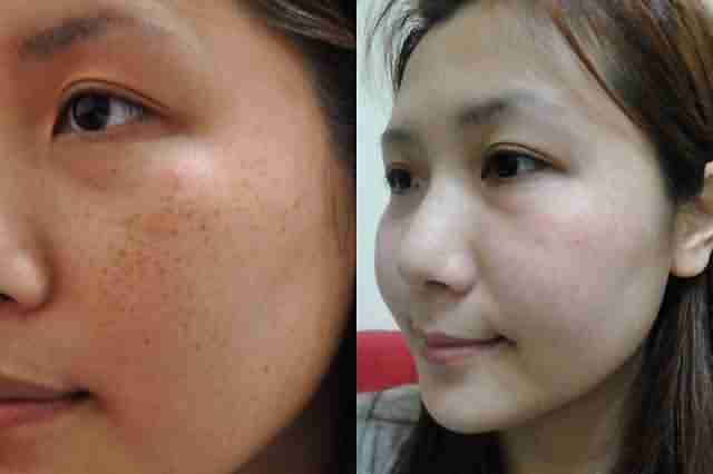 黄褐斑会造成哪些危害-lni