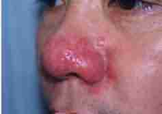 酒渣鼻的症状有哪些-lni