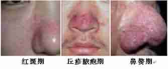 酒渣鼻的症状有哪些-lni