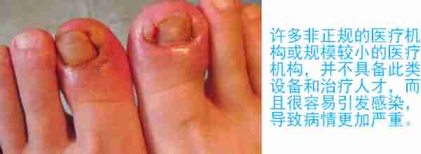 治疗甲沟炎的费用要多少-lni