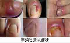 兰州治疗甲沟炎哪家医院好-lni