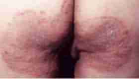 股癣是怎么生成的-lni