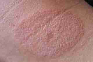 兰州治疗体癣需要多少钱-lni