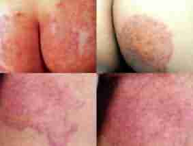 什么方法可以有效治疗股癣-lni