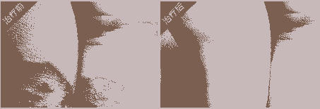 兰州治疗体癣需要多少钱-lni