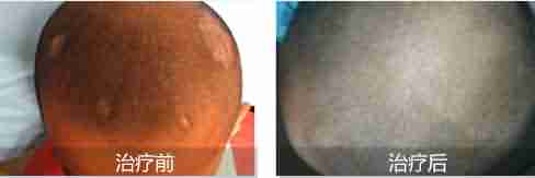 头癣有哪些症状-lni