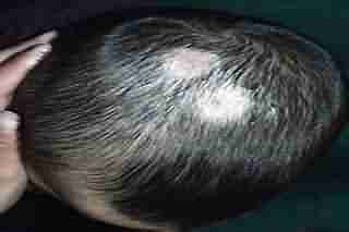 头癣有哪些症状-lni