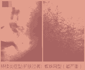 ��Ѫ˿�շ�ԭ������Щ-lni