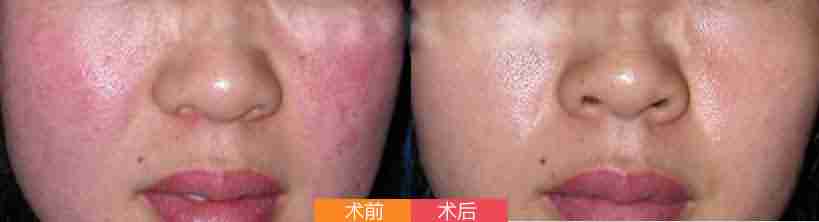 ��Ѫ˿��֢״����Щ-lni