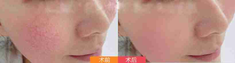 ��Ѫ˿��֢״����Щ-lni