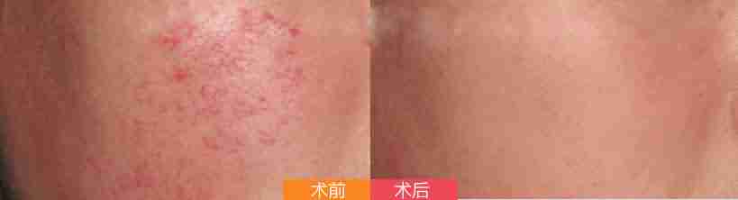 ��Ѫ˿��֢״����Щ-lni