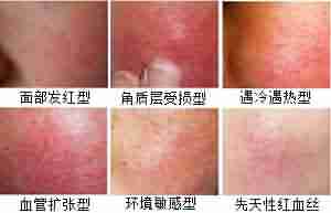 ��Ѫ˿��֢״����Щ-lni