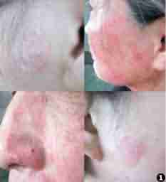 治疗皮肤癣 选择医院是关键-lni