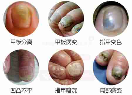 ��ʶ��Ѣ֢״����������Ч����-lni