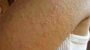 毛周角化的病因分析-lni