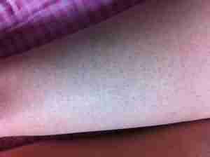 毛周角化的病因分析-lni