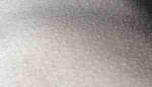 毛周角化的病因分析-lni