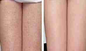 毛周角化的病因分析-lni