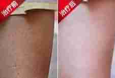 毛周角化的病因分析-lni