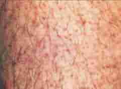 医生讲解毛周角化主要症状表现-lni