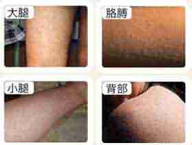 警惕毛周角化的危害-lni