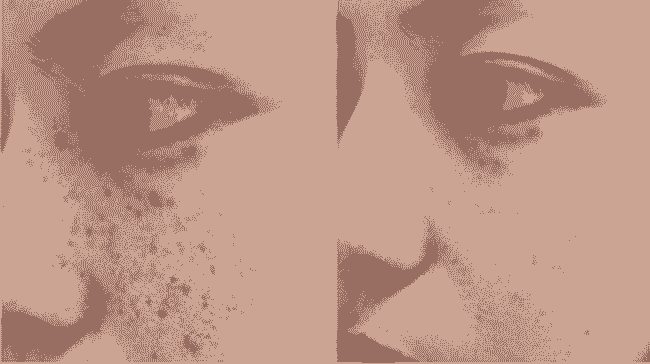 雀斑会给我们带来哪些危害-lni