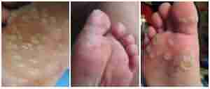 跖疣的症状表现有哪些-lni