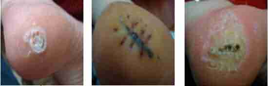 跖疣有哪些危害-lni