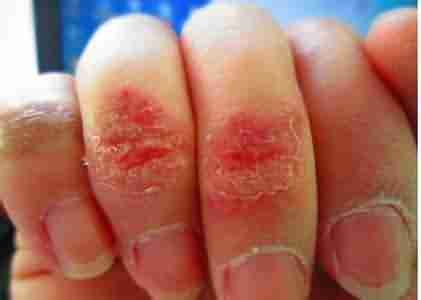 警惕冻疮危害 及时治疗有保障-lni