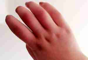 治疗冻疮 正规公立医院有保障-lni