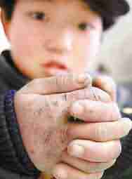 挖掘冻疮根本成因 做到标本兼治-lni