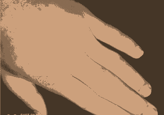 ҽ�����������ķ���֢״-lni