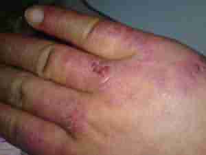 NG-Y型冻疮热动力疗法-lni